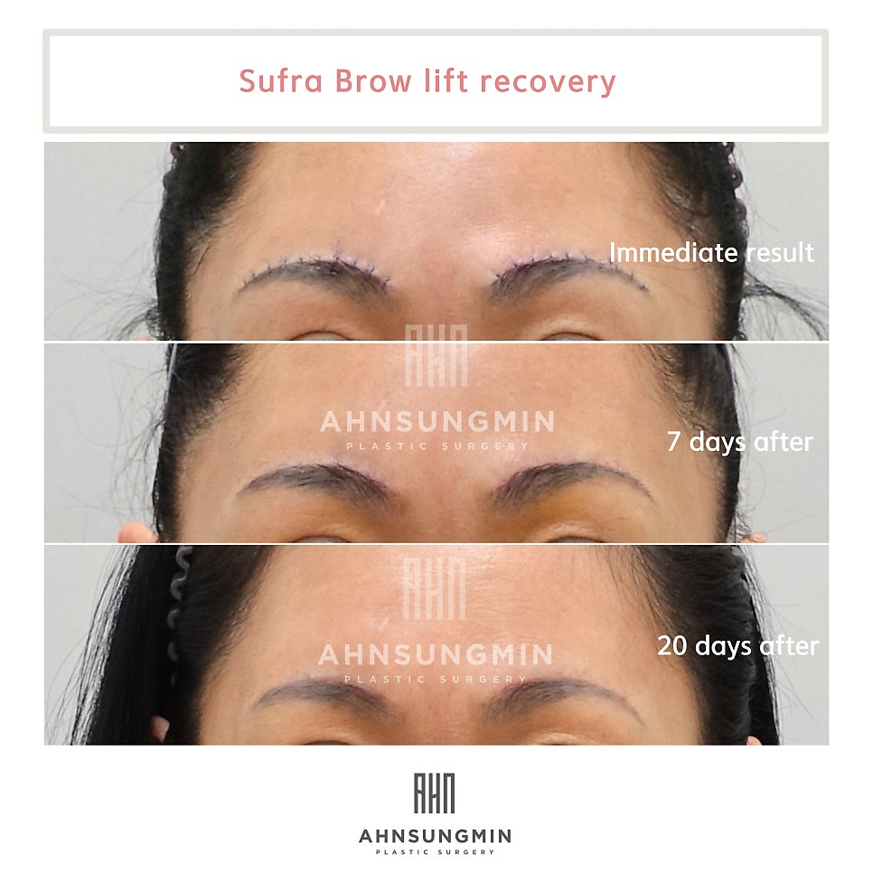 눈썹상거상 흉터와 회복과정 관련 이미지 2