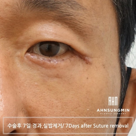 중년 남자 눈 밑 수술 후회 없이 안전하게 잘하려면 [성형외과 전문의 안성민] 관련 이미지 5