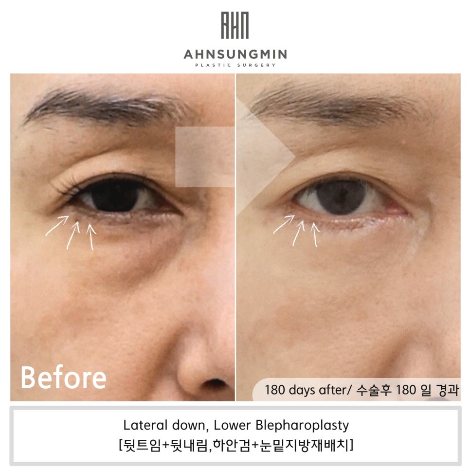 뒷트임과 하안검 수술의 공통 수술 범위. 성형외과 전문의 안성민 관련 이미지 7