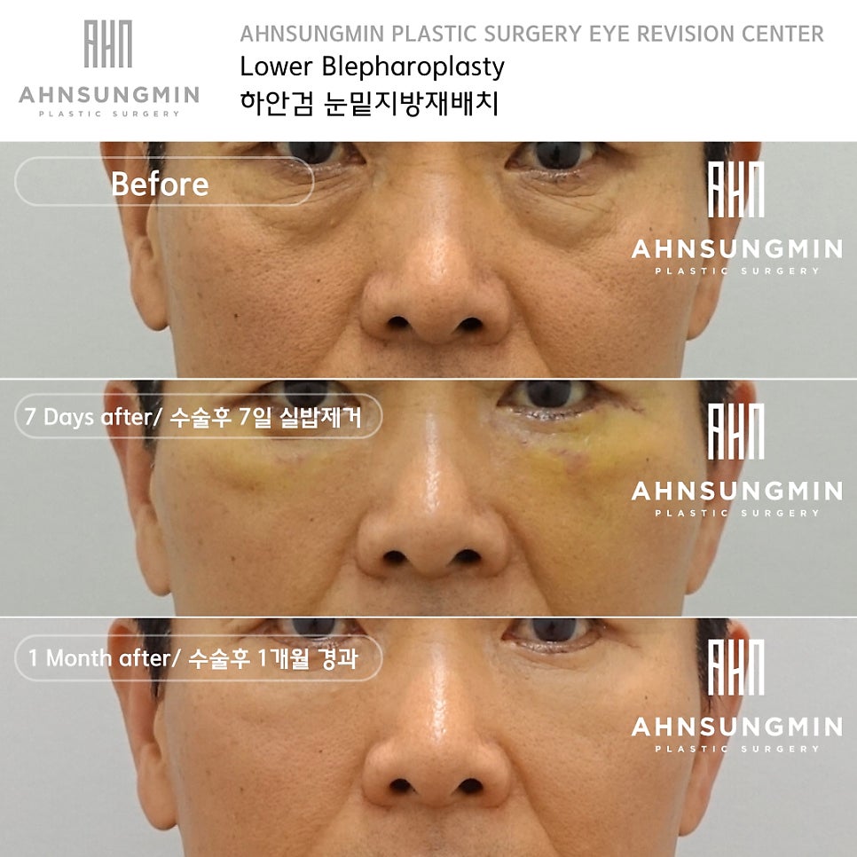 하안검 재수술 잘하려면 [성형외과 전문의 안성민] 관련 이미지 4