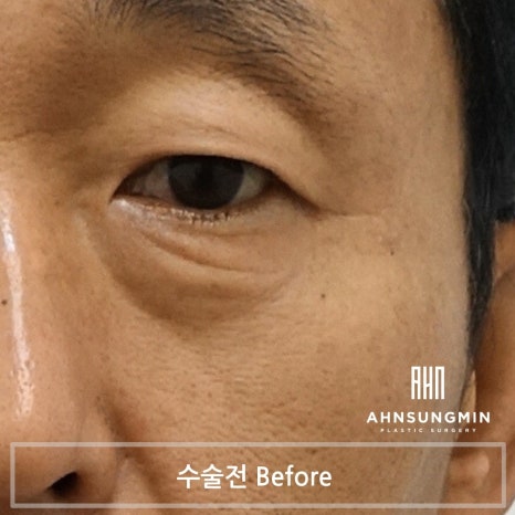 중년 남자 눈 밑 수술 후회 없이 안전하게 잘하려면 [성형외과 전문의 안성민] 관련 이미지 3
