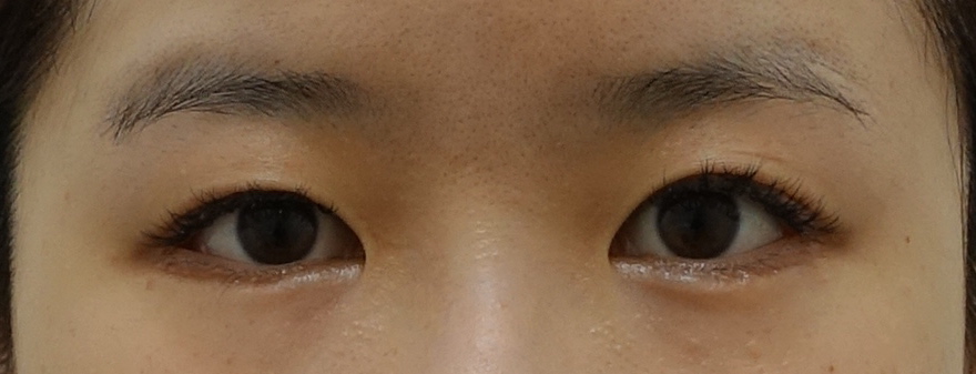 성형외과전문의 안성민이 말하는 트임수술 관련 이미지 4