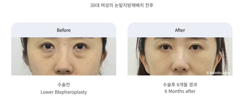 불룩한 눈 밑 지방, 해결할 수 있을까? 관련 이미지 6