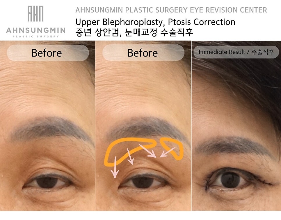 중년 여성의 상안검 수술 주의사항과 혈압관리 관련 이미지 3