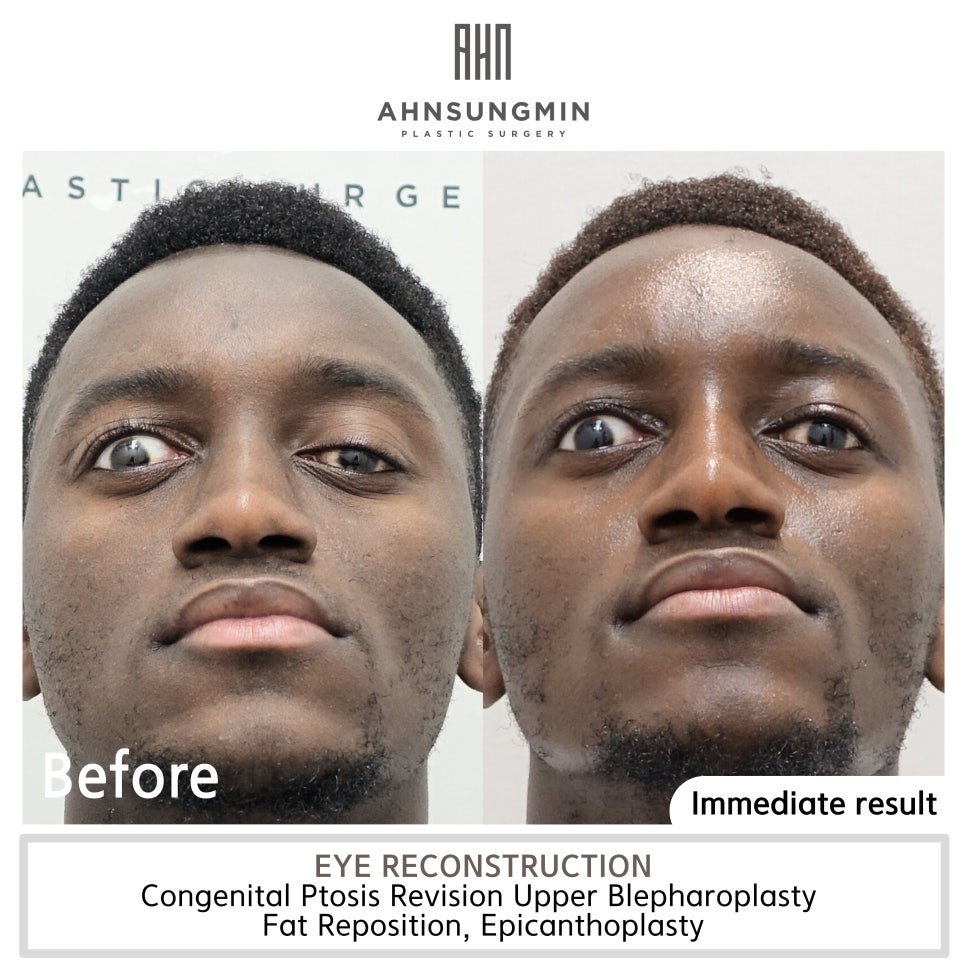 선천성 안검하수 재수술 짝짝이교정 관련 이미지 2