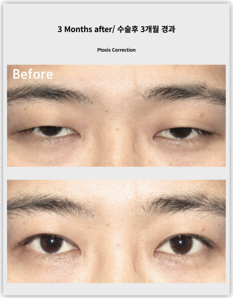 20대 중증 안검하수 수술 후 3개월 경과 관련 이미지 7