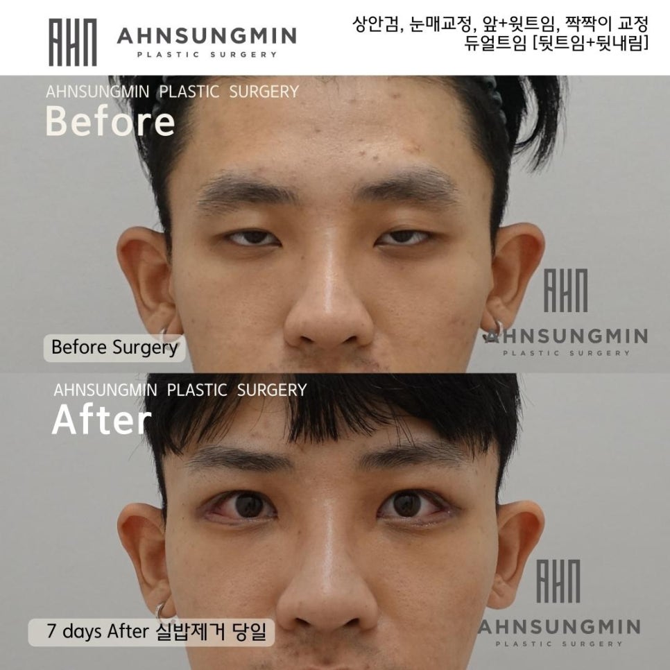 남자안검하수와 트임성형 [ 날카로운눈 온화한 인상으로] 눈이 커지고 싶어요 관련 이미지 4