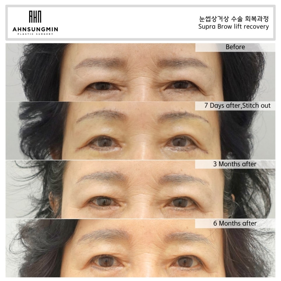 눈꺼풀 처짐을 해결하는 방법, 눈썹 거상 수술이 필요한 경우 관련 이미지 6