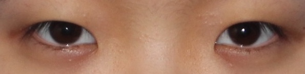 앞트임 수술이란? 내안각 교정술 Epicanthoplasty, 몽고주름 앞트임 성형술 관련 이미지 1