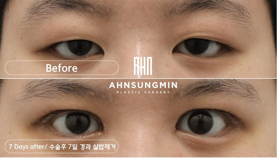 눈이 왜 졸려보일까? 졸린눈 무겁고 졸린 눈의 원인은 안검하수 관련 이미지 3