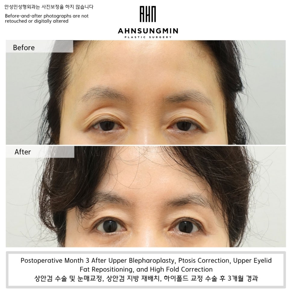 Upper Eyelid Hollowness That Develops With Age Is Not Simply Caused by Fat Loss image 3