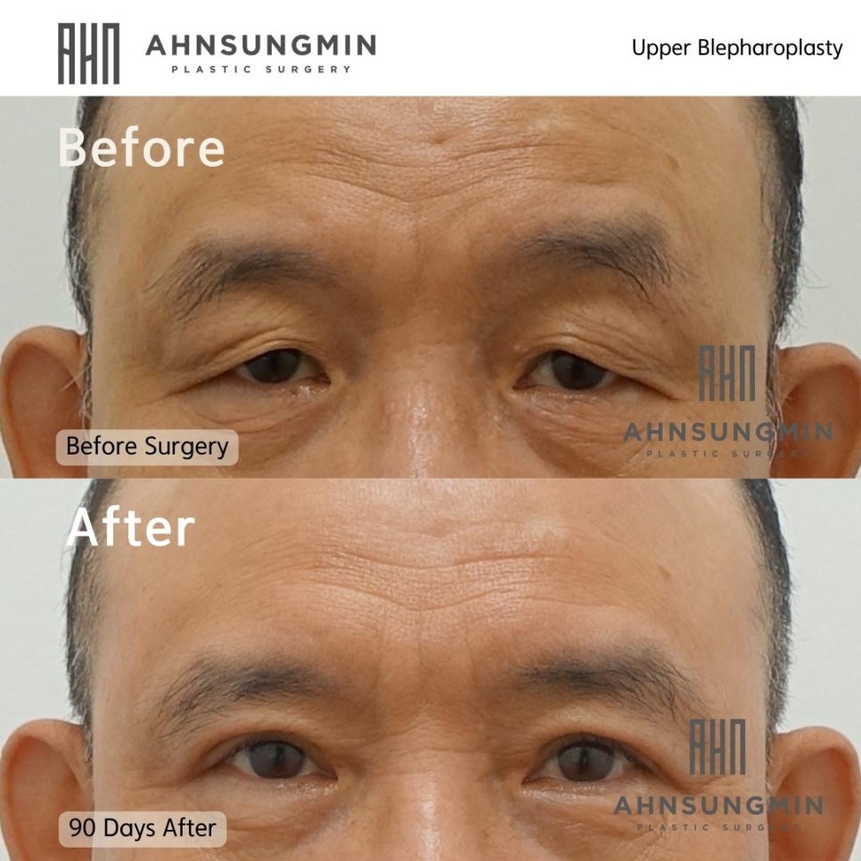 중년남성의 상안검 수술 회복기간은 어떻게 될까요? 관련 이미지 4