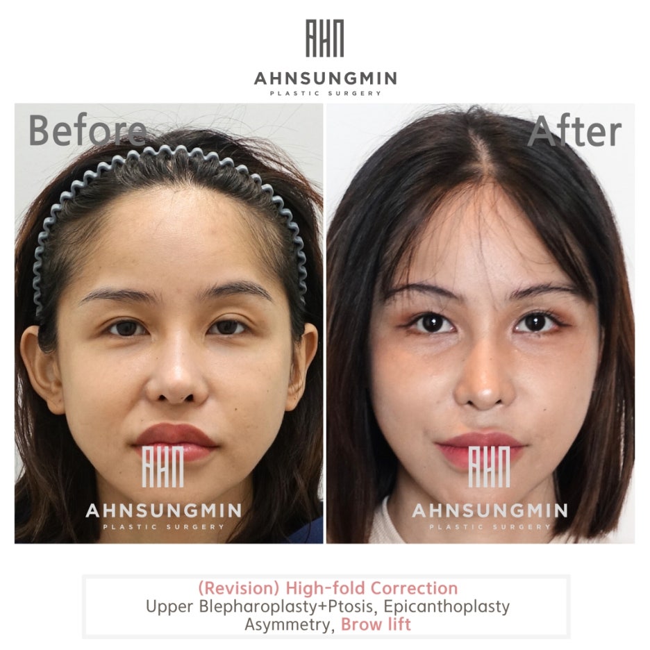 눈썹하거상 수술의 부작용과 눈썹상거상 수술이 필요한이유 관련 이미지 4