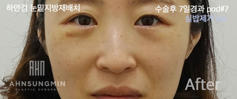 [안성민 성형외과]하안검지방재배치 고객님입니다^^ 관련 이미지 4