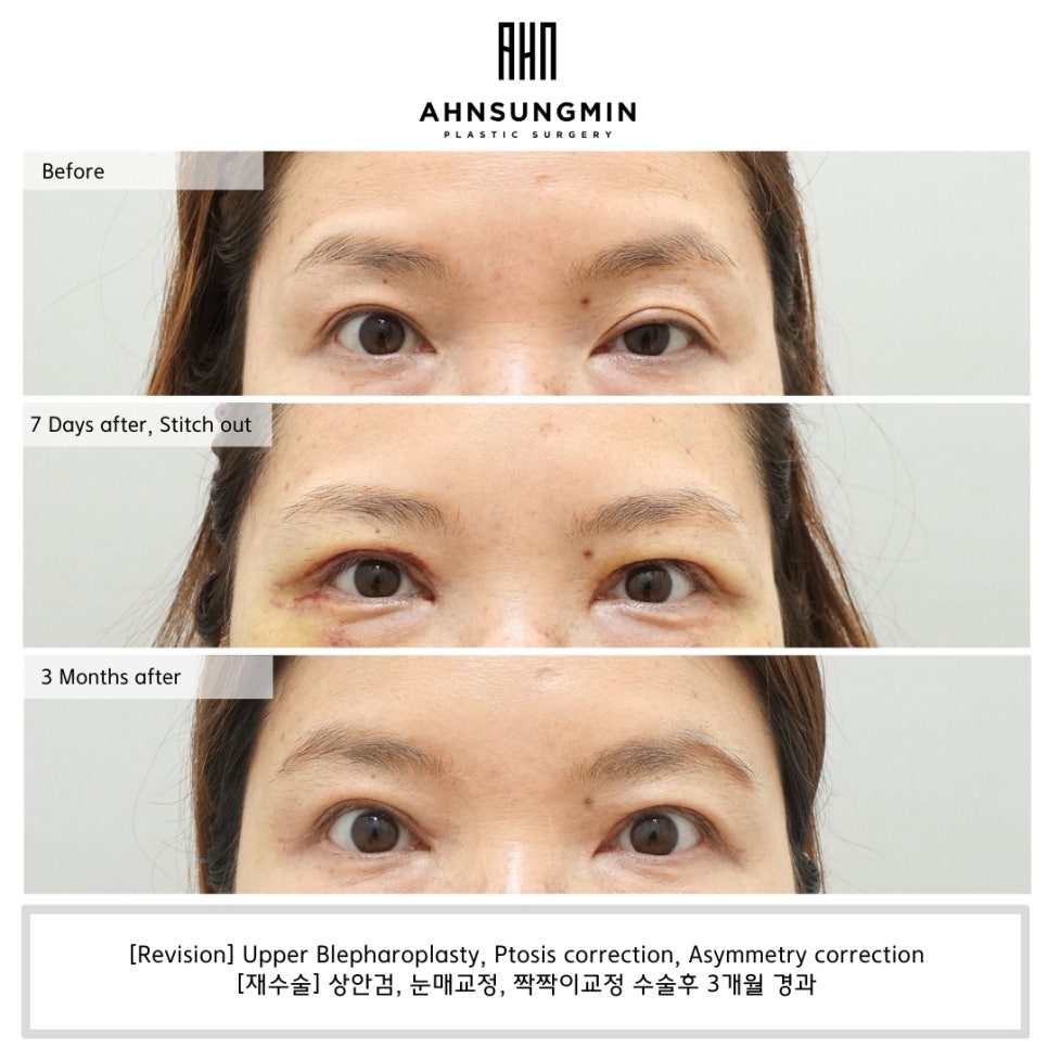 짝짝이 눈 한쪽만 교정할 수 있을까? 관련 이미지 2