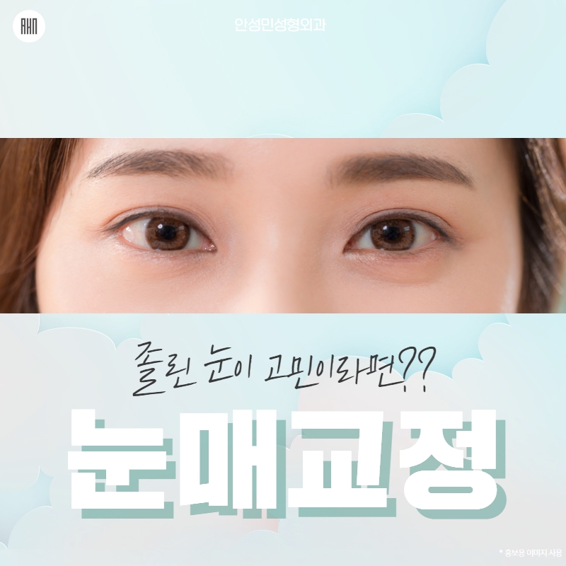 짝눈교정 절개 비절개 어떤 방법이 좋을까? 관련 이미지 1