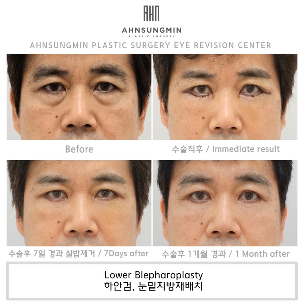중년 남성의 하안검, 나도 젊어질 수 있을까? 관련 이미지 3