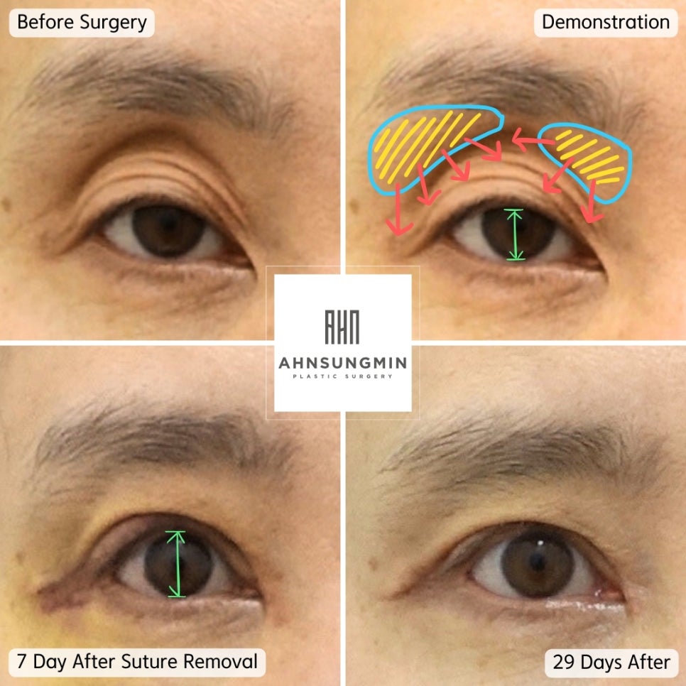 중년눈꺼짐 안와지방이동 과정 관련 이미지 2