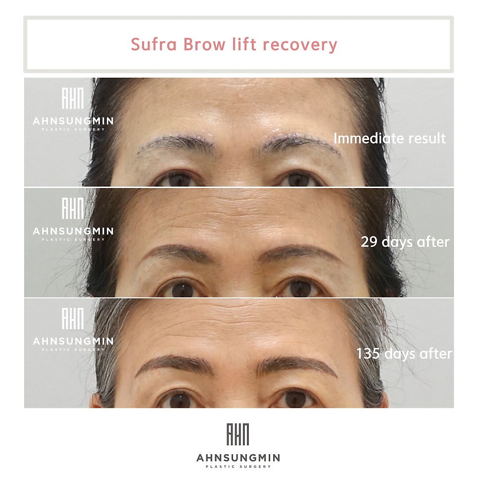 눈썹상거상후 눈썹문신(반영구문신) 가능한 시기 관련 이미지 4