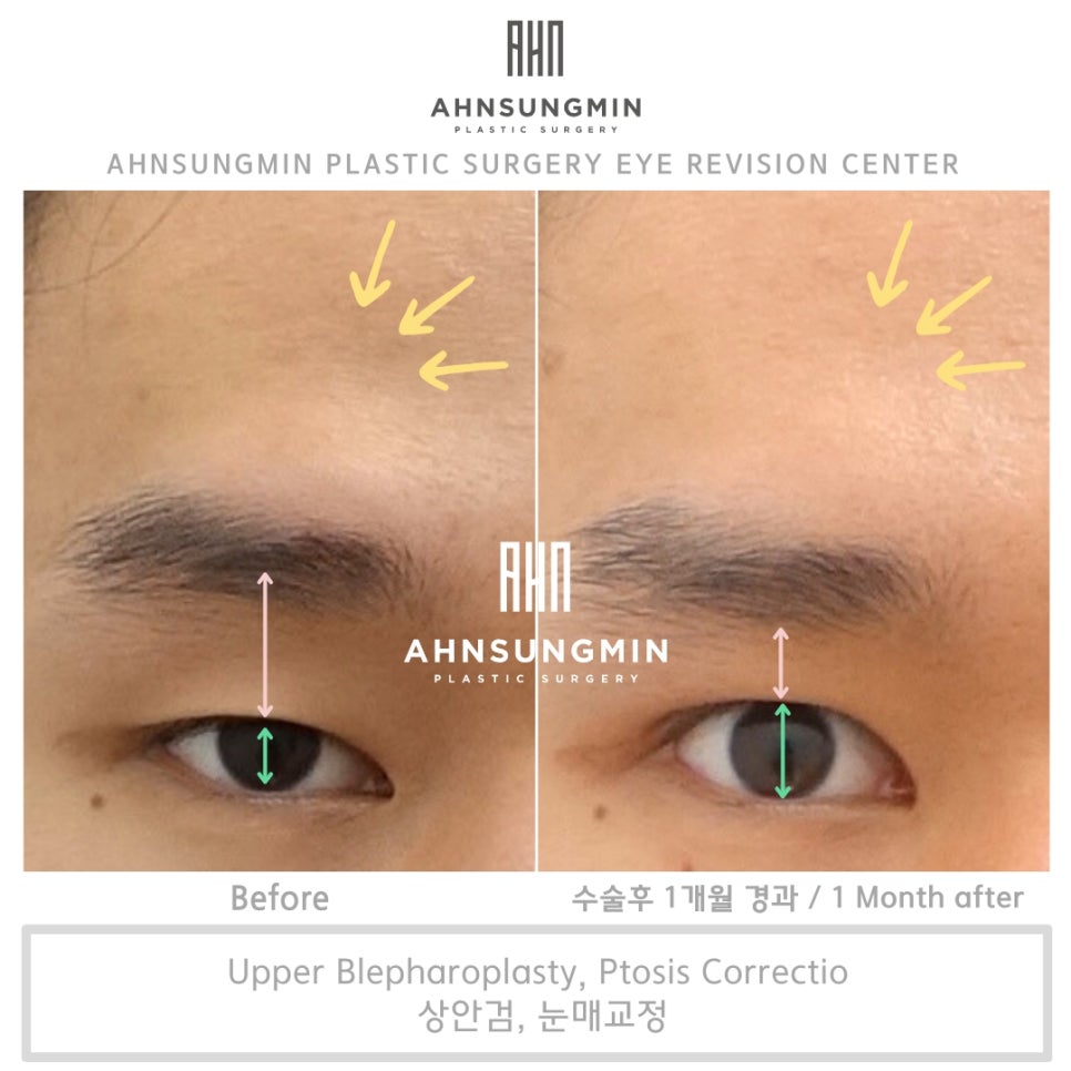 미세한 차이가 주는 매력적인 눈 남자 눈매교정 잘하는 병원 관련 이미지 4