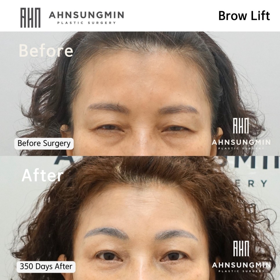 눈썹 하거상 수술의 부작용과 눈썹 상거상 수술이 필요한 이유 관련 이미지 3
