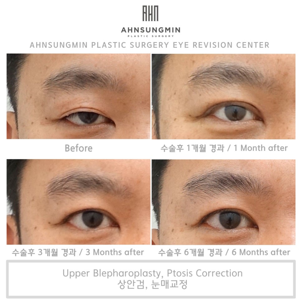 눈두덩이가 무겁고 답답해요. 내눈도 혹시 안검하수? 관련 이미지 3