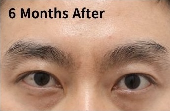 쌍꺼풀 재수술 후 눈은 언제 자연스러워질까? (Day 1부터 6개월 변화) 관련 이미지 7