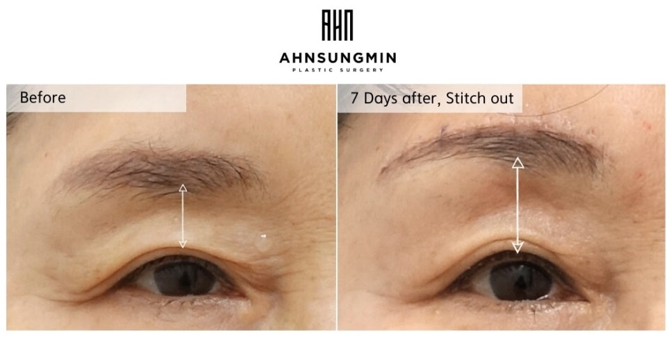 60대 눈썹상거상술 전후 비교, 눈이 편안해진 이유 관련 이미지 3