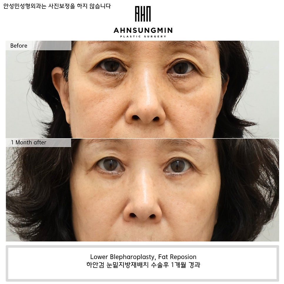 하안검 수술 시 중안면 근육을 당기는 이유 관련 이미지 2