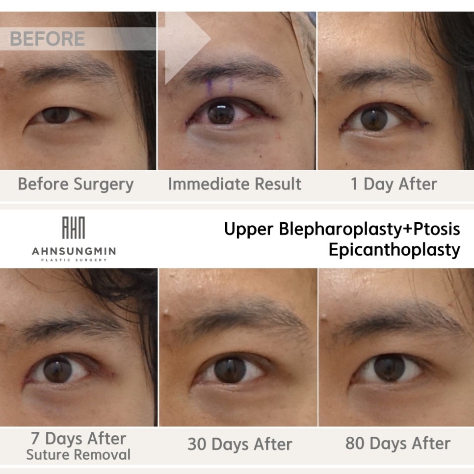 남자 안검하수 눈매교정 회복과정 관련 이미지 2