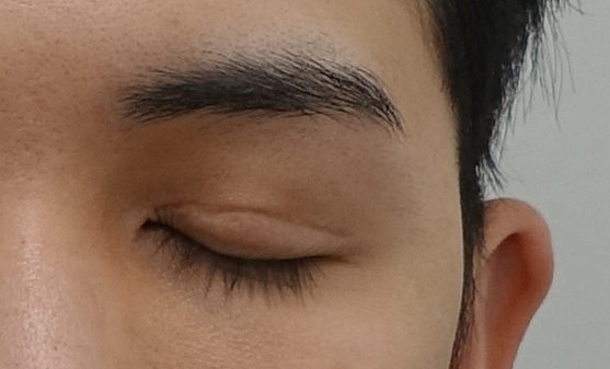 쌍꺼풀 비대칭과 비후증의 원인과 해결 방법, 성형외과 전문의 안성민 관련 이미지 4