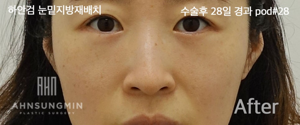 [안성민 성형외과]하안검지방재배치 고객님입니다^^ 관련 이미지 5