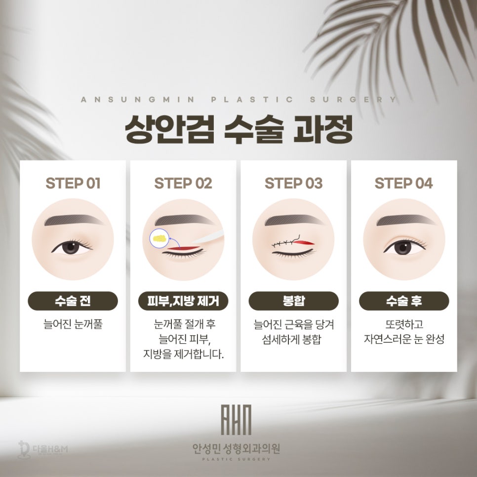 안성민 성형외과 전문의 상안검 수술의 정석 관련 이미지 4