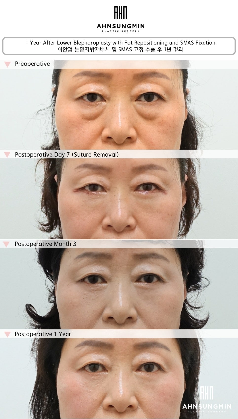 하안검 눈밑지방재배치 수술 1년 경과, 결과는 어떻게 달라질까? 관련 이미지 2