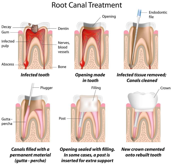 역삼동 크라운 치과 치료 필요한 치아상태, 꼭 확인하세요. 관련 이미지 4