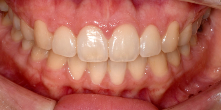 잇몸성형가격? 비용, 주의사항, 치료 후기 공개 관련 이미지 12