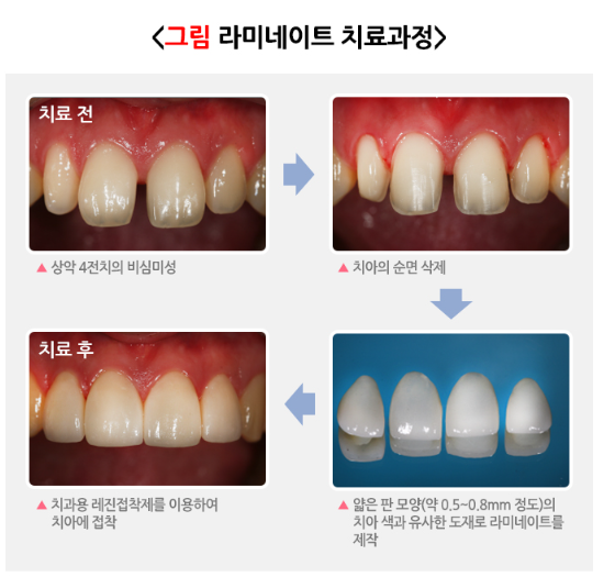 라미네이트 후 변색되는 이유, 대부분 여기서 갈립니다 관련 이미지 3