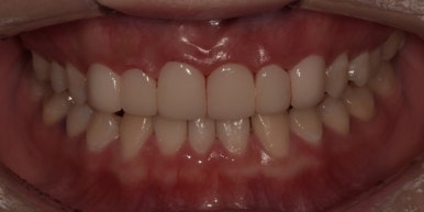 왜소치(작은치아)라미네이트? 치아 모양과 크기, 바꿀 수 있습니다. 관련 이미지 6