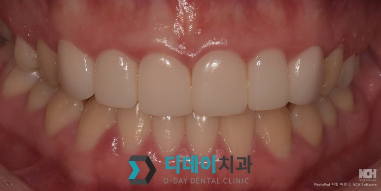 라미네이트 비용 차이나는 이유 의사가 직접 설명합니다 관련 이미지 8