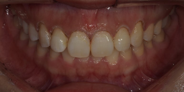 잇몸성형 비용과 자주묻는 질문 답변까지 이 글로 정리합니다. 관련 이미지 4
