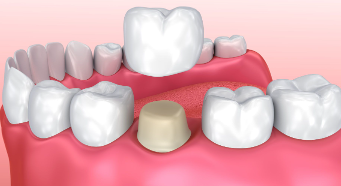 라미네이트 후회하시는 분들 공통점 3가지 관련 이미지 6