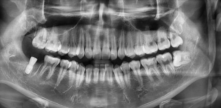 젊은나이임플란트? 젊을수록 더 빨리 심어야합니다. 관련 이미지 4