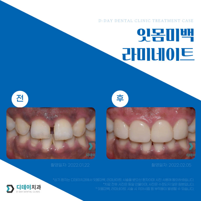 앞니라미네이트가격, 이 글 보시면 손해볼 일 없습니다. 관련 이미지 8