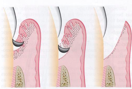 강남 치주잇몸소파술 치과, 손해 보기 싫다면? 관련 이미지 5