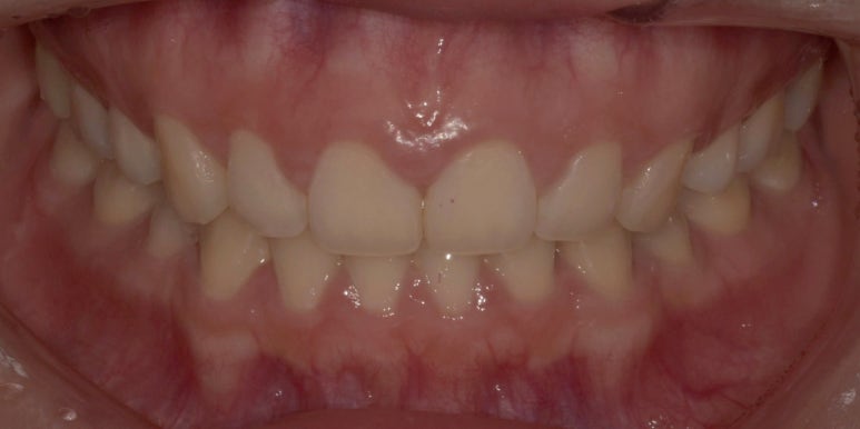 잇몸성형, OO해서 후회해요&hellip; 후회하는 이유는? 관련 이미지 7