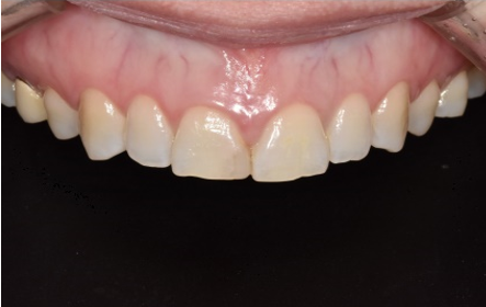 언주역치과? 이 2가지는 꼭 확인하세요. 관련 이미지 3