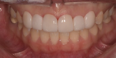 라미네이트 전후사진과 치료비용까지 숨김없이 알려드립니다. 관련 이미지 13