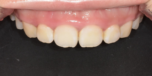 잇몸절제? 절개없이 레이저로 잇몸성형한 후기 관련 이미지 6