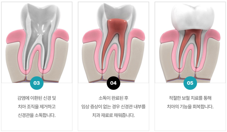 충치치료기간, 치료별 내원횟수와 기간까지 총정리 관련 이미지 9