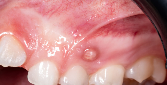 어금니잇몸물집, 방치하면 안 되는 이유 의사가 직접 설명합니다 관련 이미지 8